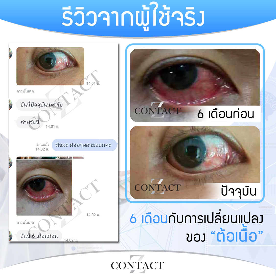 คอนแทคซี ฟื้นฟูดวงตา