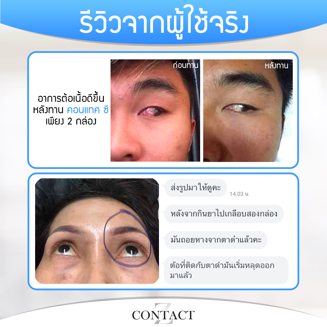 คอนแทคซี ฟื้นฟูดวงตา