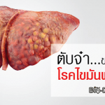ไขมันพอกตับ